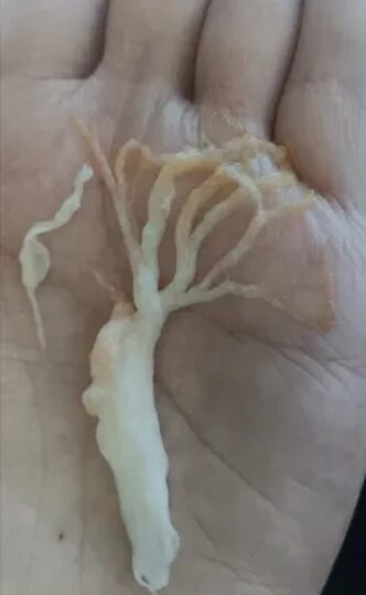 Người phụ nữ ho ra "rễ cây"